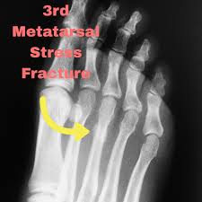 Image result for Fracture XRay
