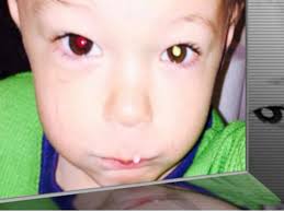 Smartphone helps diagnose toddler's eye cancer