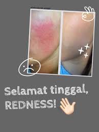 … kalau iya, anda wajib tahu tentang bagaimana cara menghilangkan jerawat dengan cepat dalam semalam berikut ini. Biar Redness Di Wajah Ilang 101 Storie