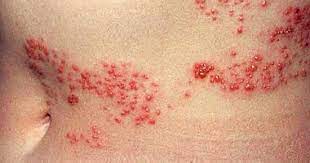 كما قلنا سابقًا أن عدوى الحزام الناري لا تنتقل من شخص لشخص ولكن الفيروس نفسه الذي يسبب الحزام الناري يمكن أن ينتقل لشخص لآخر ويسبب له الجدري المائي إذا لم يصاب به من قبل، وبالتالي إذا أصيب. Ø§Ø³Ø¨Ø§Ø¨ Ø§Ù„Ø§ØµØ§Ø¨Ø© Ø¨Ø§Ù„Ø­Ø²Ø§Ù… Ø§Ù„Ù†Ø§Ø±Ù‰ Ù…Ù†Ù‡Ø§ Ø¶Ø¹Ù Ø¬Ù‡Ø§Ø² Ø§Ù„Ù…Ù†Ø§Ø¹Ø© Ø§Ù„ÙŠÙˆÙ… Ø§Ù„Ø³Ø§Ø¨Ø¹