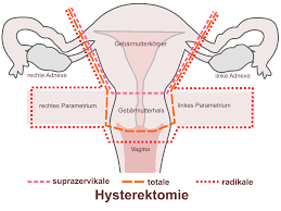 Declension of participles of perfect masculines of verbs, vocative singular. Hysterektomie Wikipedia