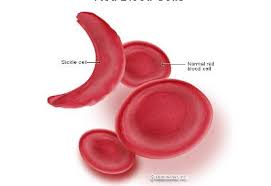 Maybe you would like to learn more about one of these? Sel Darah Merah Berbentuk Bulan Sabit Yang Bikin Sengsara