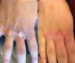 Image result for Postinflammatory Hypopigmentation