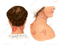 Image result for Secondary Syphilis