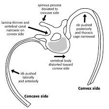 Rib cage, basketlike skeletal structure that forms the chest, or thorax, made up of the ribs and their the rib cage surrounds the lungs and the heart, serving as an important means of bony protection for. Adam S Forward Bend Test Physiopedia