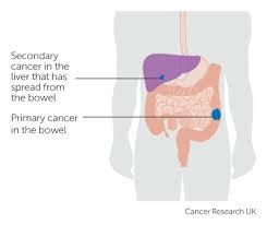 This refers to cancer that has spread (metastasized) to areas farther away from where your cancer was first located. How Cancer Can Spread Cancer Research Uk