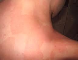 الذئبة الحُمامية الجلدية (cutaneous lupus erythematosus): Ù†Ø³Ø§Ø¡ ÙŠØªØ­Ø¯ÙŠÙ† Ø§Ù„Ø°Ø¦Ø¨Ø© ÙˆØ¯ Ø§Ù„Ø¹Ø±ÙŠØ¨ÙŠ Ø­Ø§Ù„Ø§Øª ÙƒØ«ÙŠØ±Ø© ÙÙŠ Ø§Ù„Ø¨Ø­Ø±ÙŠÙ† ØµØ­ÙŠÙØ© Ø§Ù„ÙˆØ·Ù†