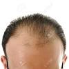 Elles peuvent être diverses, et on parle d'alopécie ou de perte de cheveux androgénétique lorsque la perte de cheveux est. 1