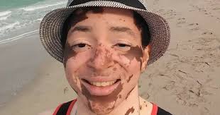 These People With Vitiligo Remind Us That What Describes Us Doesn't Define  Us