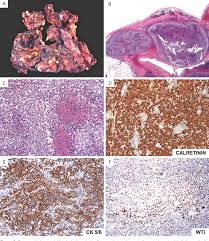 Malignant pleural mesothelioma (mpm) is a rare cancer that is refractory to current treatments. Figure 2 From Erionite Associated Malignant Pleural Mesothelioma In Mexico Semantic Scholar