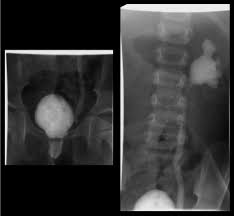 Image result for Voiding Cystourethrogram