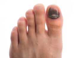 The signs of toenail fungus are actually thick toenails or black toenails may not be your typical toenail fungus symptoms, but could at. Don T Let Black Toenails Scare You Haro Podiatry Laser Center