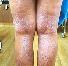 A New Treatment For Atopic Dermatitis Or Eczema The Star