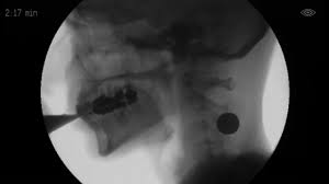 Painful swallowing isn't likely to be cancer. Trouble Swallowing Pills What To Do For Pill Dysphagia Swallow Study Swallow Study