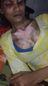 Acid attack Trans woman still struggling for bread and butter. Story of Karima  Khan