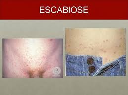 A escabiose, vulgarmente conhecida por sarna, é uma infestação cutânea contagiosa, que resulta numa erupção da pele com um padrão característico, causando intensa comichão. Doenas De Pele Na Infncia Internato Escs Amanda