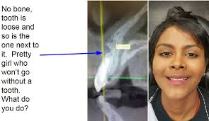 A transitional prosthesis