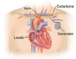 The subcutaneous icd (sicd) is a novel defibrillator developed over the past decade that has become available to patients in the united states this year. Implantable Cardioverter Defibrillator Icd Saint Luke S Health System