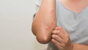 kurdesen nedir kurdesenin nedenleri ve tedavisi anneler kadinlar kulubu