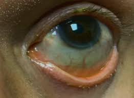 Image result for lesion sclera
