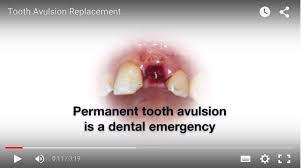 Image result for Tooth Avulsion