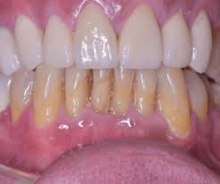 You should be fully healed from a gum graft in one to two weeks. Gum Graft Surgery Treatment In Tijuana For Receding Gumsdental Clinic Dentists In Tijuana