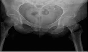 Migration Of Ventriculoperitoneal Shunt To Urethral And Rectal Orifices Bmj Case Reports
