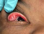 Check spelling or type a new query. Floppy Eyelid Syndrome Eyewiki