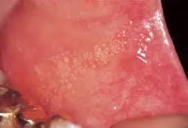Tiny bumps on mouth roof. What Virus Or Allergy Can Cause Hundreds Of Tiny Bubbles On The Inner Lip And Cheek Areas Quora