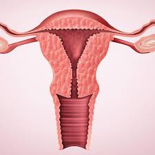 Alasan wanita penderita penebalan dinding rahim susah hamil tebal endometrium wanita normalnya antara 8mm hingga 13mm, tergantung pada tahap siklus menstruasi dan hormon estrogen. Berbahayakah Penebalan Dinding Rahim Ini Faktanya