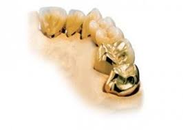 Where to sell dental gold. 48 Sell Dental Gold Ideas Gold Buyer Dental Gold