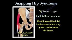 Image result for Snapping Hip