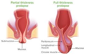 Image result for Rectal prolapse