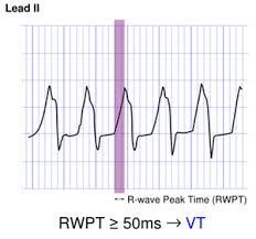 Image result for R Wave