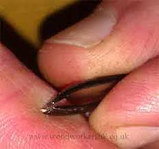 Many materials have been proposed to draw out splinters. Removing A Splinter How To Get A Splinter Out Gate Expectations