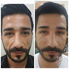 Yuz Dolgu Uygulamasi Ortalama 5 Ile 8 Yil Kalicilik Ve Dogal Gorunum Dogal Gorunum Yuzler Dogal