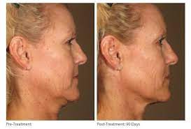 Maybe you would like to learn more about one of these? 2 Treatments To Get Rid Of A Turkey Neck The Cosmetic Skin Clinic