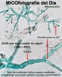 La mucormicosis es una infección rara con alta morbimortalidad causada por hongos invasivos. Xblkwg9u4dnpxm