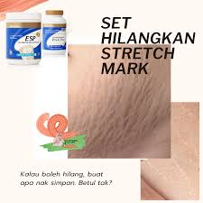 Cara ampuh hilangkan bekas luka di kulit. Petua Hilangkan Stretch Mark Selepas Bersalin Shidarahmat