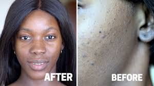 10 best vitamin c supplements 2021. My Experience Using Vitamin C And Retinol C20 Serum And Tretinoin Drug Review Youtube