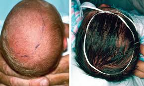 Image result for Craniotabes