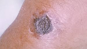 Image result for Anthrax