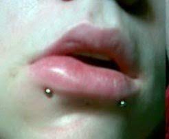 Infected Lip Piercing Diagnosis Home Treatment
