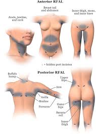 Bodytite The Science And Art Of Radiofrequency Assisted Lipocoagulation Rfal In Body Contourin Body Contouring Surgery Body Skin Tightening Body Contouring