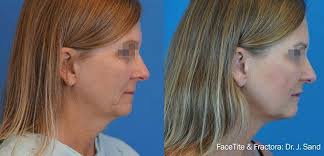 Check out inmode embracerf in detail in venkat center for skin & plastic surgery. Embracerf Inmode Australia