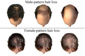 Genetics passed from one generation to another also leads to alopecia areata. Hair Fall Treatment In Delhi Prp Dermaworld Skin Clinic