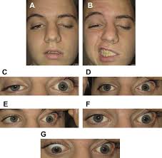 Image result for Pupillary Paralysis