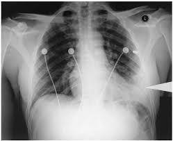 Image result for Pulmonary Contusion