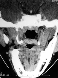Durante más de 1 mes. Mucormicosis Rinocerebral En Un Nino Diabetico Tratamiento Conservador