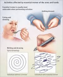 In some cases, hand tremor may be a signal of neurological issues or degenerative disease. Pin On Essential Tremor